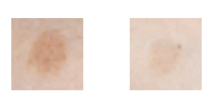 1.紫外線による色素沈着抑制効果